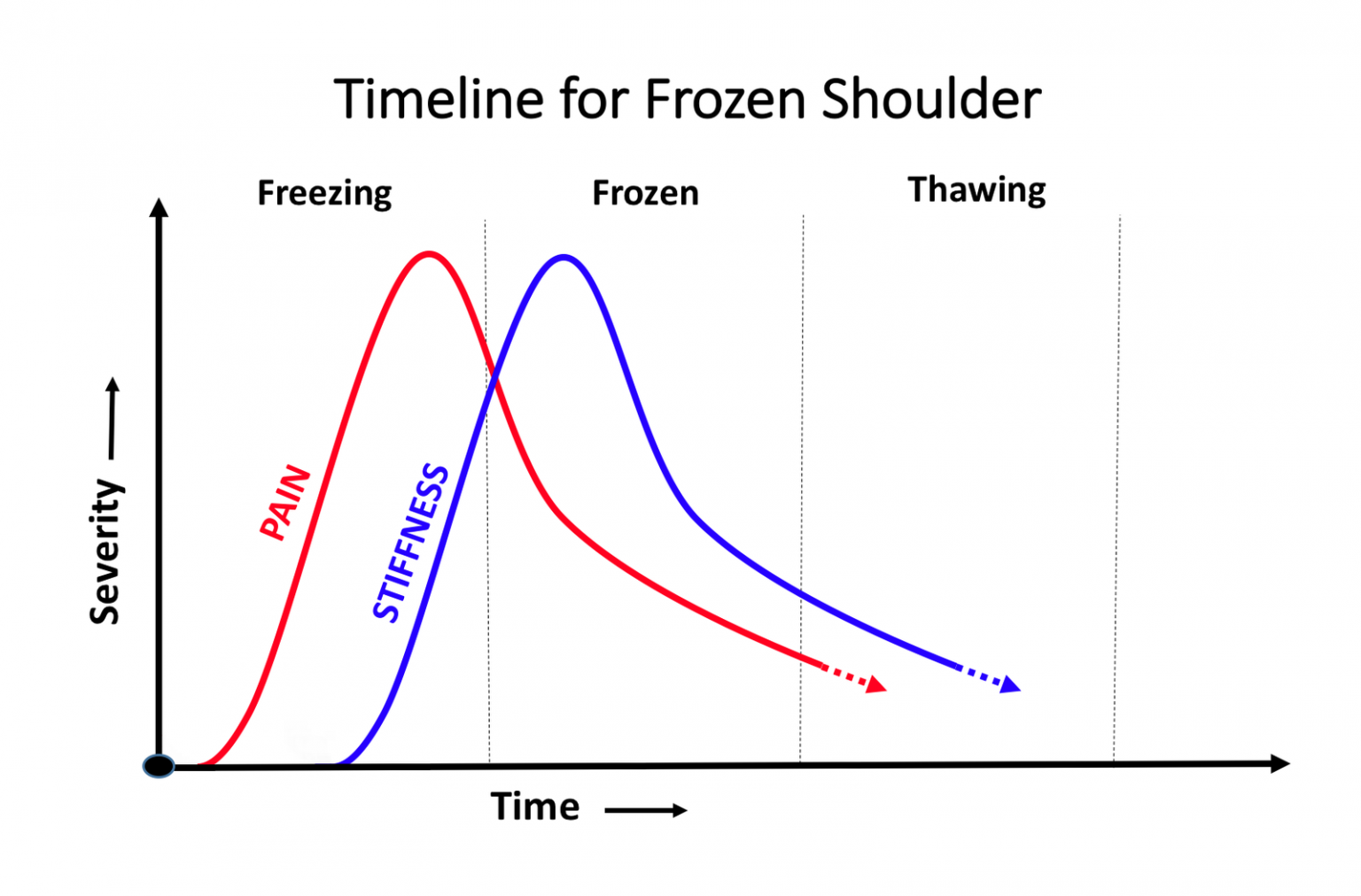 frozen shoulder