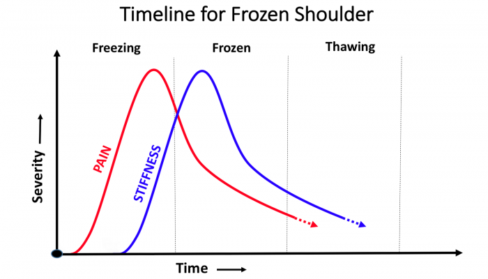 2.+Timeline-for-Frozen-Shoulder